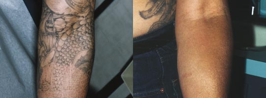 Tattoo Removal London | Laser Tattoo Removal London | Laser Tatoo Removal